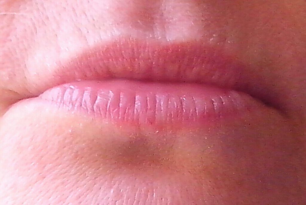Новая технология восстановления красной каймы губ